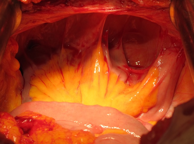Вид операционной - органы малого таза в виде единого конгломерата