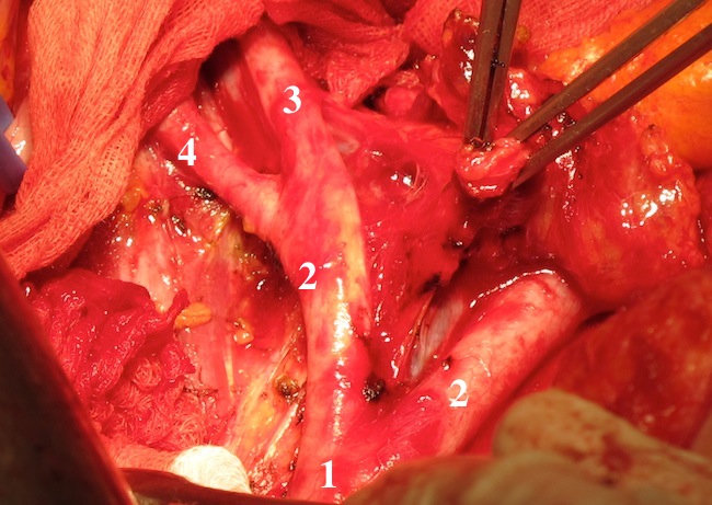 Скелетизация подвздошных артерий