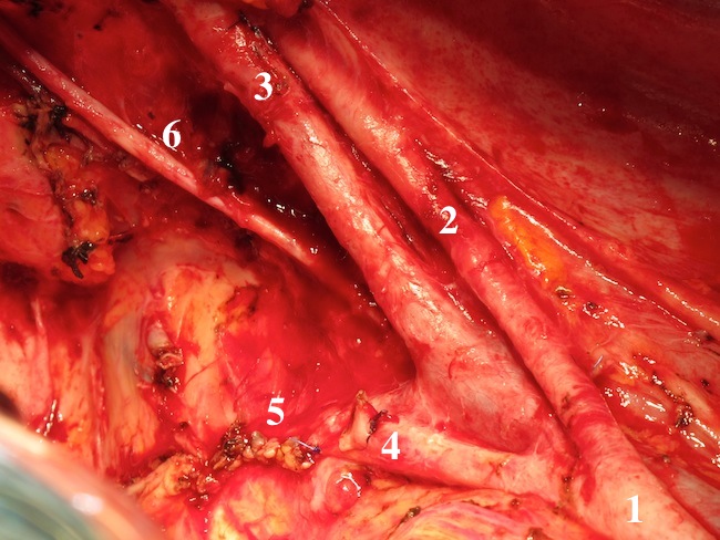 Скелетированная правая боковая стенка таза