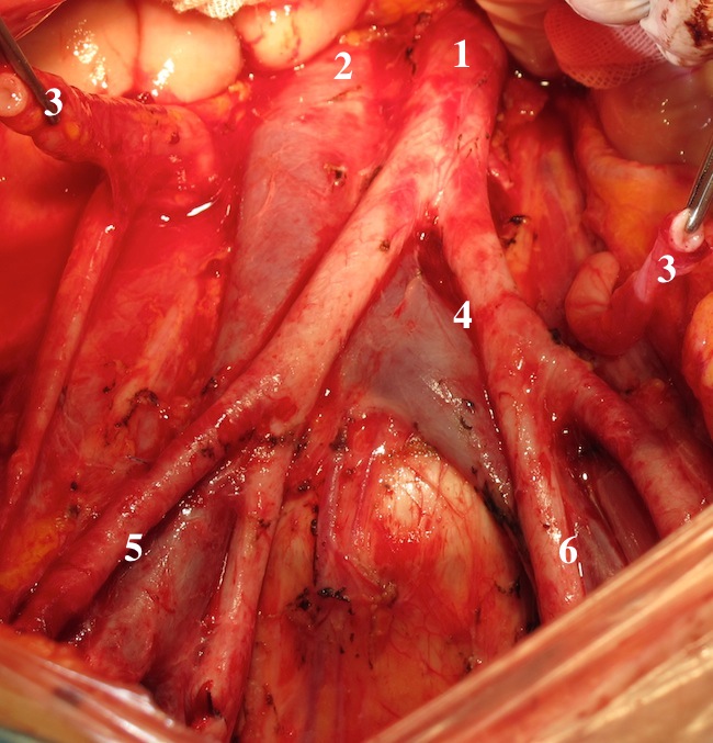 Скелетированные аорта и ее ветви