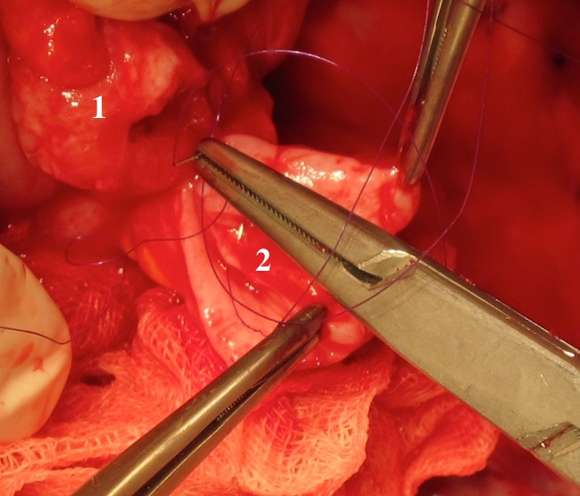 Формирование уретероколоанастмоза по Wallace