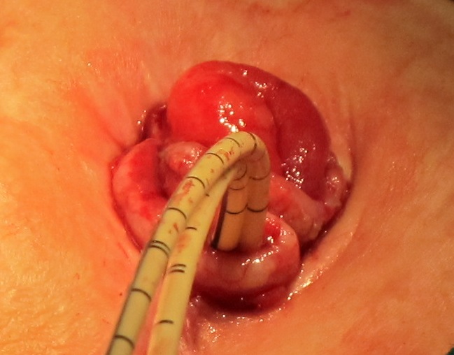 Комбинированная двуствольная влажная стома