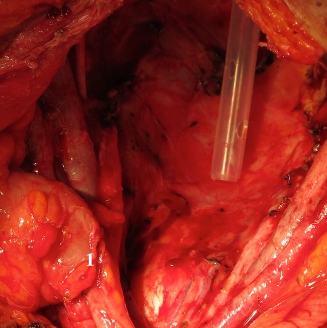 Дренаж в полости малого таза после его эвисцерации