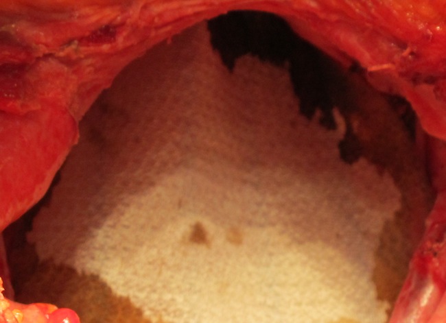 Формирование тазового дна сеткой PROCCED