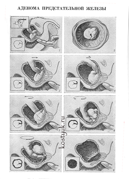 Удаление аденомы простаты по Федорову-Фрейеру