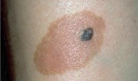 Одна из разновидностей рака кожи - меланома