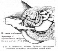 Абсцесс Дугласова пространства, способ диагностики при ректороманоскопии