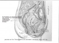 Аденокарцинома железистого эпителия матки с инвазией в мочевой пузырь