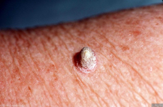 Кожный рог - вид факультативного предрака