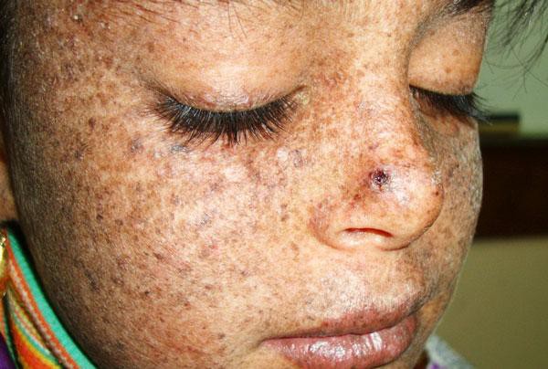 Пигментная ксеродемия - вид облигатного предрака