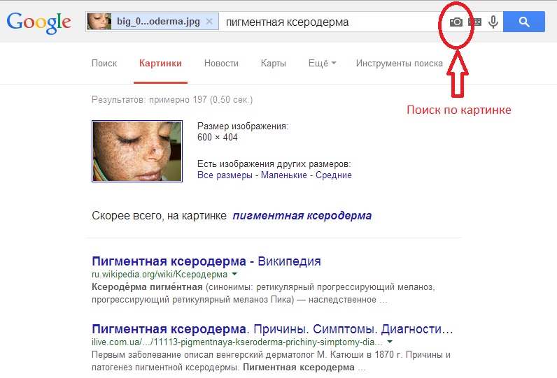 Пигментная ксеродермия - разновидность предрака, рак кожи симптомы фото