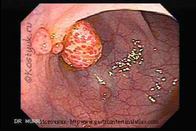 Эндоскопическая диагностика онкологичских заболеваний Эндоскопическая диагностика онкологичских заболеваний