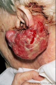 Рак кожи мочки уха