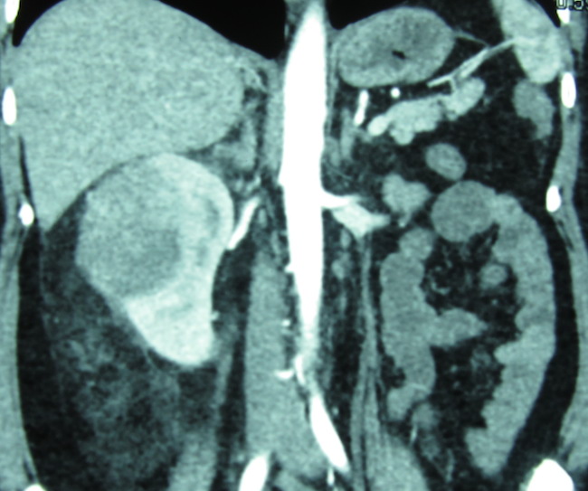 злокачественная шванома