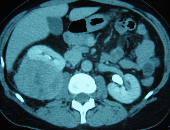 злокачественная шванома