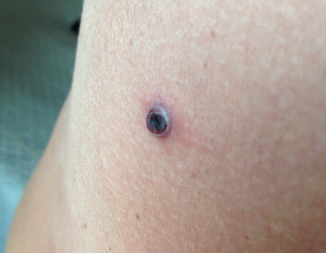 иравмированный невус