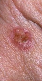 Комедоновый невус