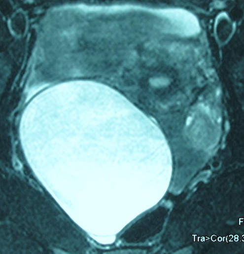 Киста правого яичника