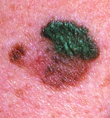 Поверхностно распространяющаяся меланома