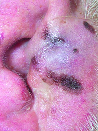 Лентиго-меланома