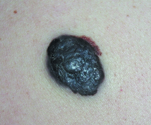 Узловая меланома