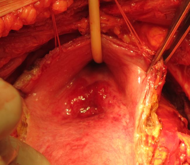 Рак прямой кишки, распространяющийся на треугольник Льето мочевого пузыря
