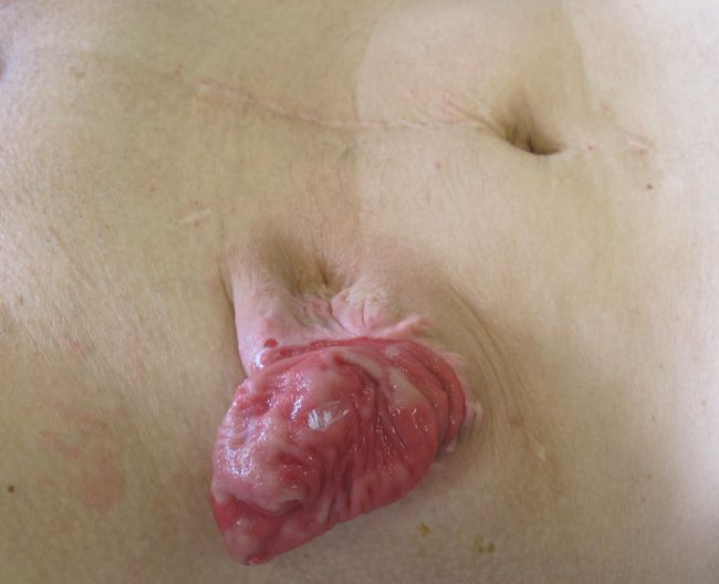 Порочно сформированная колостома