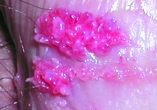 Остроконечные кондиломы