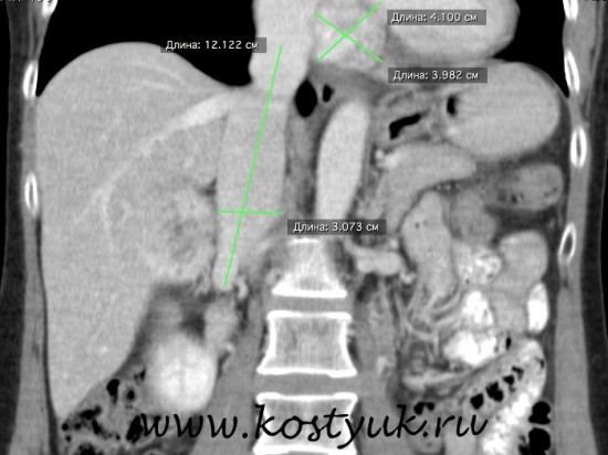 Тромб в нижней полой вене с переходом в правое пердсердие