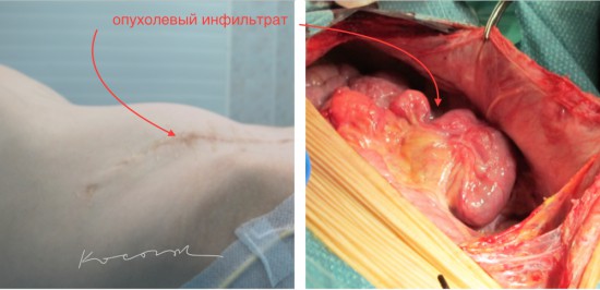 Рецидив рака слепой кишки