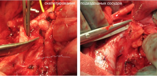 Отделение опухоли от наружных подвздошных сосудов и нижней полой вены