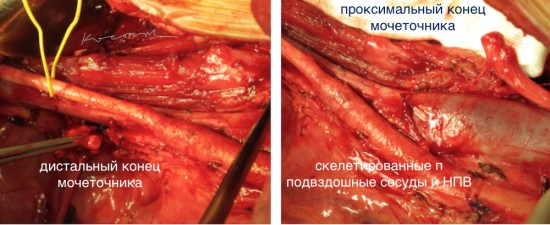 Ложе опухоли после ее удаления