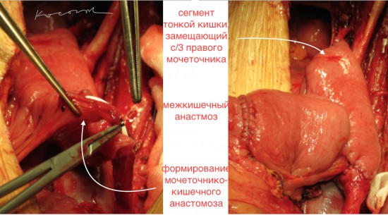 Тонкокишечная пластика резецированного сегмента мочеточника