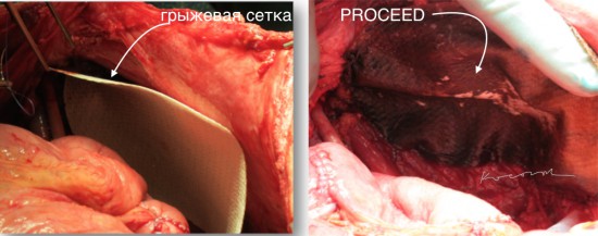 Пластика мышечно-апоневротичексого дефекта сеткой PROCEED