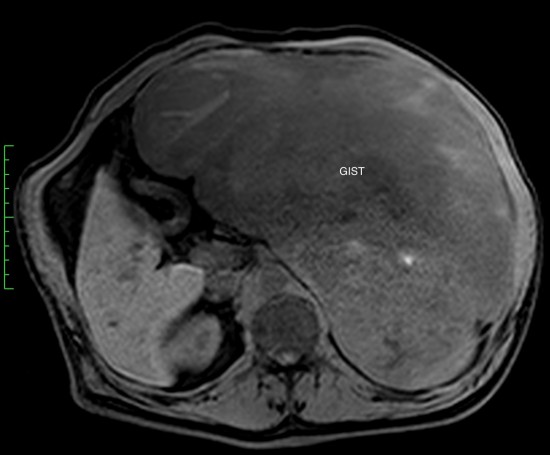 Гастроинтестинальная стромальная опухоль гигантских размеров, исходящая из большой кривизны желудка