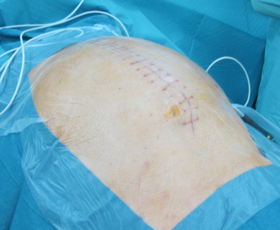 Пациент на операционном столе. Рубец после эксплоративной лапаротомии.