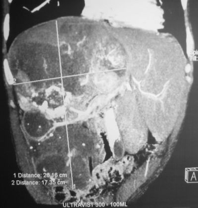 КТ органов брюшнйо полости