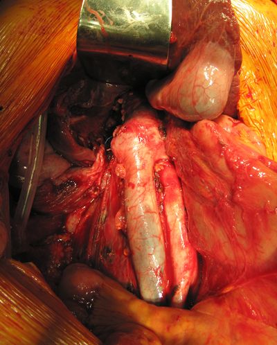 Ложе почки после ее удаления