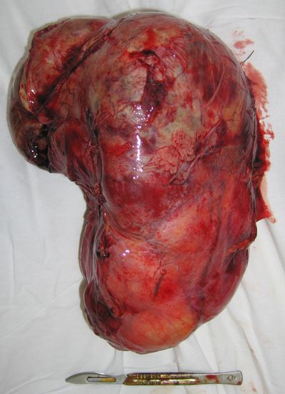 Удаленная почка