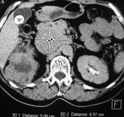 Компьютерная томограмма