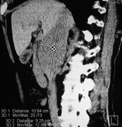 Компьютерная томограмма
