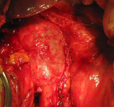 Мобилизованная вена с тромбом
