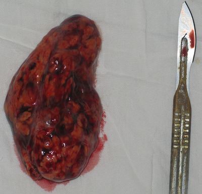 Удаленный тромб