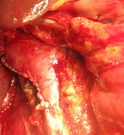 Ушитая нижняя полая вена после удаления тромба