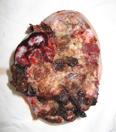 Удаленный рецдив меланомы