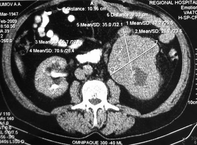 Опухоль левой почки