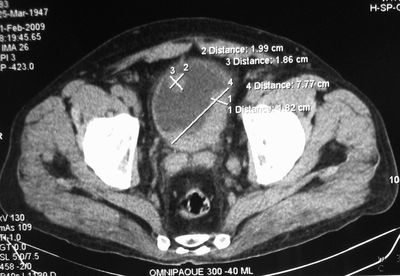 Опухоль мочевого пузыря