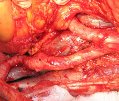 После удаления метастатически измененных лимфатических узлов