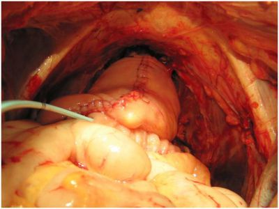 Мочевой резервуар, анастомозированный с уретрой 