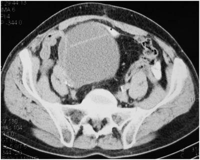 КТ через 6 месяцев (наполненный мочевой резервуар)